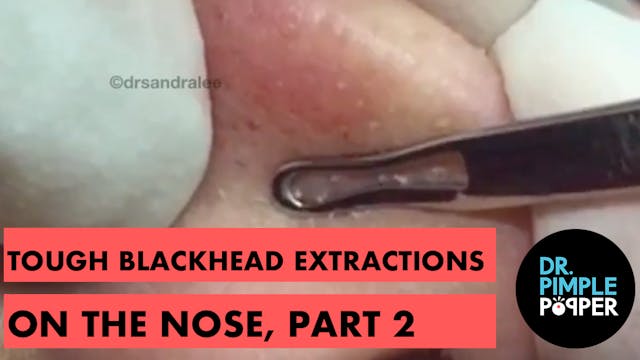 Tough blackhead extractions on the no...