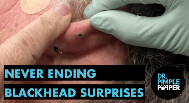 Never Ending Blackhead Surprises!