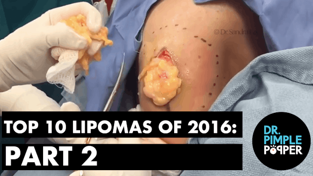 Dr Pimple Popper's Top 10 Lipomas of ...