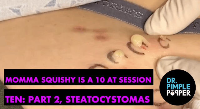 Momma Squishy is a 10 at Session Ten! Part 2, Steatocystomas