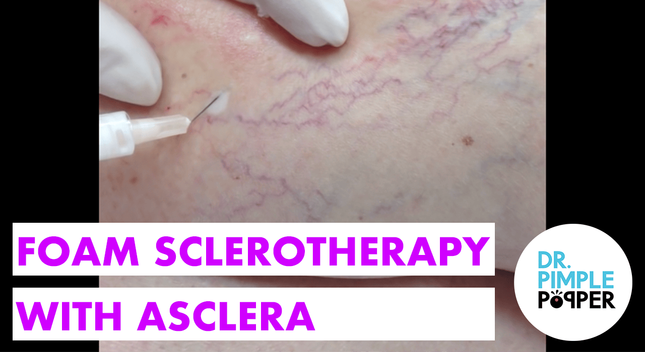 Foam Sclerotherapy Dr. Pimple Popper