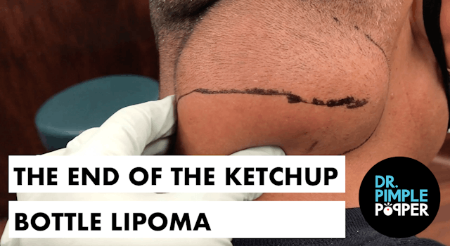The End of The Ketchup Bottle Lipoma