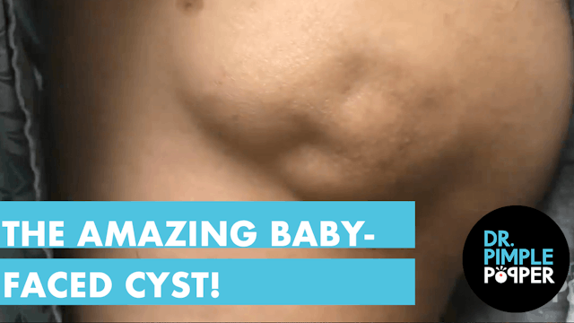 An Amazing Baby Faced Cyst!