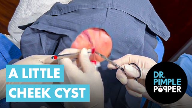 A Little Cheek Cyst