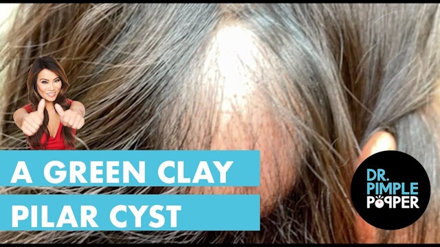 A Green Clay Pilar Cyst