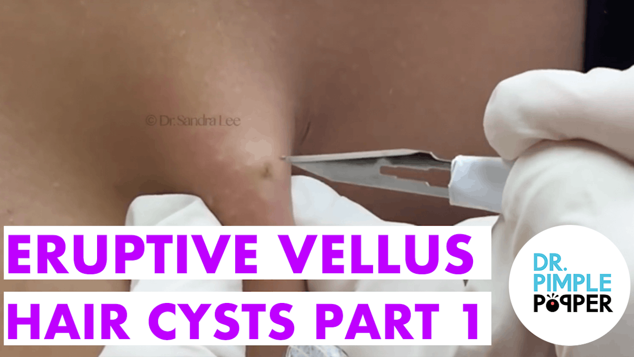 Unusual Types of Cyst: Eruptive Vellus Hair - Dr. Pimple Popper