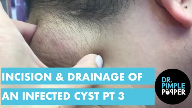 Incision & Drainage of an Infected Cy...
