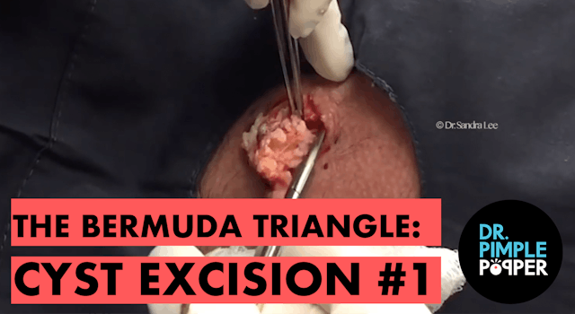 The Bermuda Triangle: Cyst Excision (Part 1)