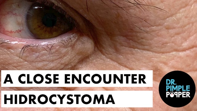 A Close Encounter Hidrocystoma