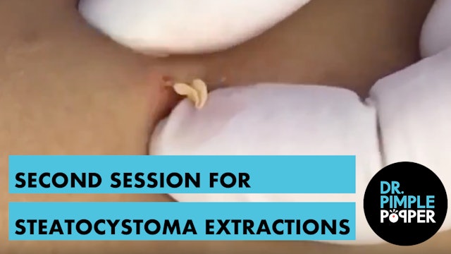 Often BETTER than Blackheads. Second session for steatocystoma extractions