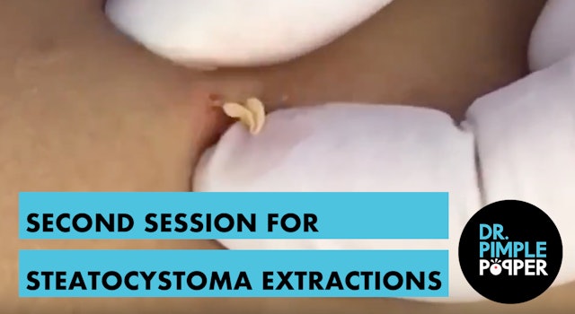 Often BETTER than Blackheads. Second session for steatocystoma extractions