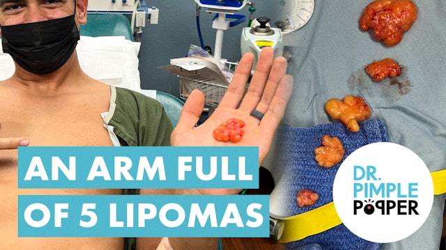 An Arm Full of FIVE Lipomas! 