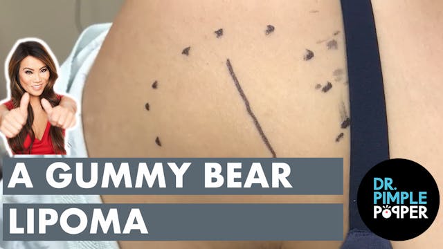 The Gummy Bear Lipoma
