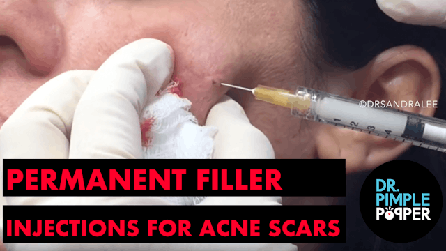 Bellafil: Permanent Filler Injections for Acne Scars