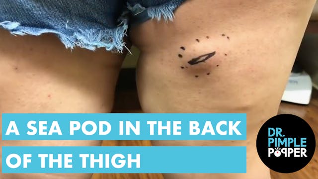 A Sea Pod in the back of the Thigh