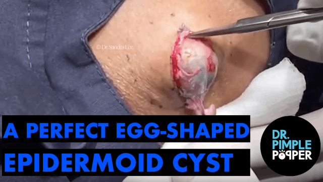 A Perfect Egg-Shaped Epidermoid Cyst