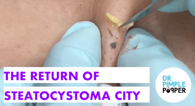 The Return of Steatocystoma City