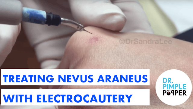 Treating Nevus Araneus (Broken Capillary)