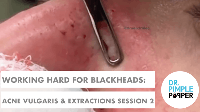 Working Hard for these Blackheads: Ac...