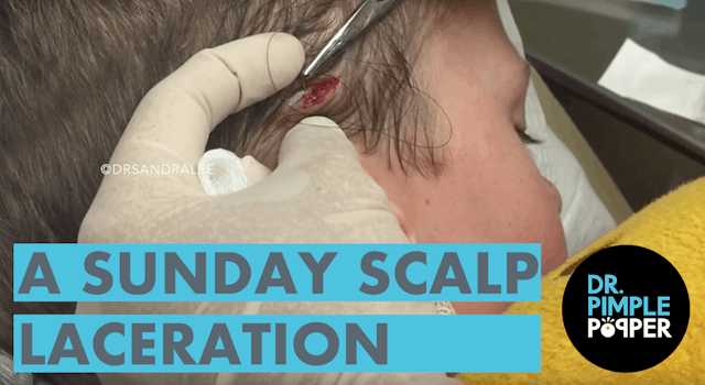 A Sunday Scalp Lasceration