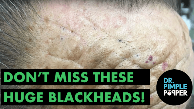 Dont Miss These HUGE Blackheads (The ...