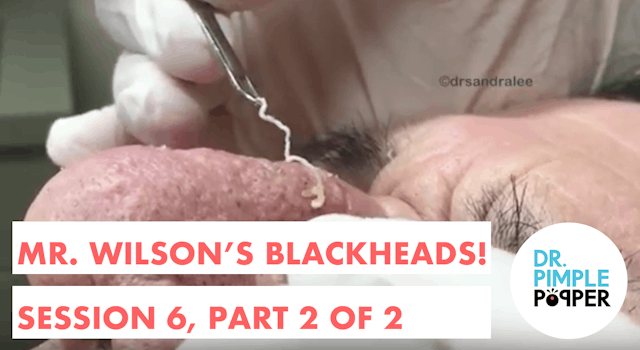 Mr Wilson's Blackhead Extractions: Se...