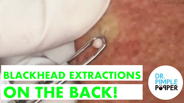 Blackhead extractions on the back, pl...