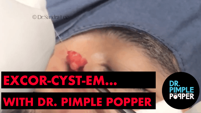 Excor-CYST-em... with Dr Pimple Popper
