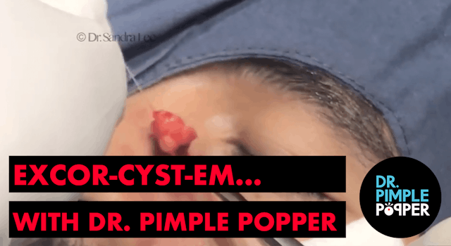 Excor-CYST-em... with Dr Pimple Popper
