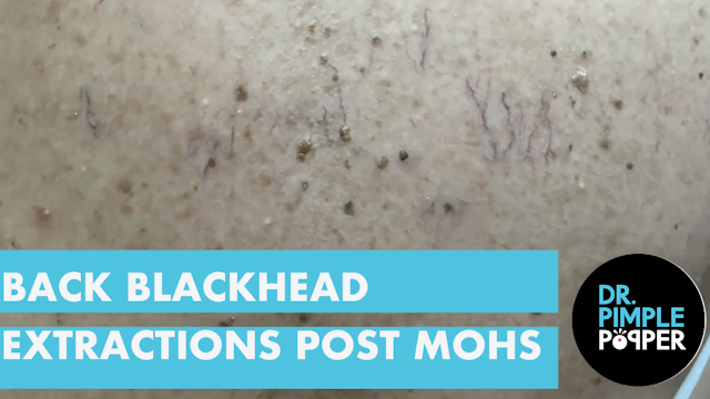 Back Blackhead Extractions after Mohs Surgery