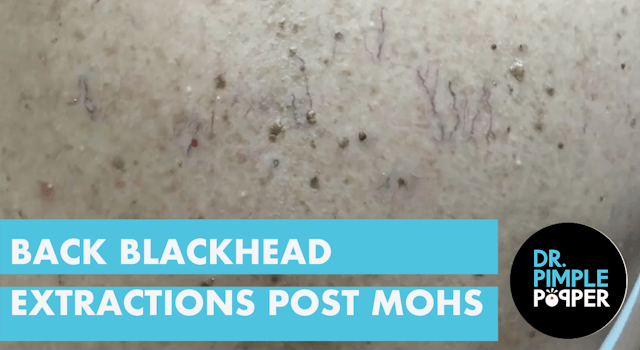 Back Blackhead Extractions after Mohs...