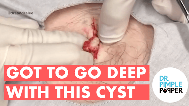 Got to go DEEP with THIS Cyst on the ...