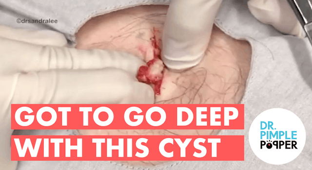 Got to go DEEP with THIS Cyst on the ...