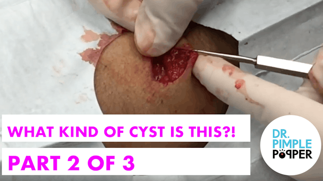 What kind of cyst is this?! Part 2 of 3