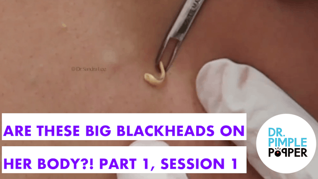 Are These Big BLACKHEADS on her Body?...