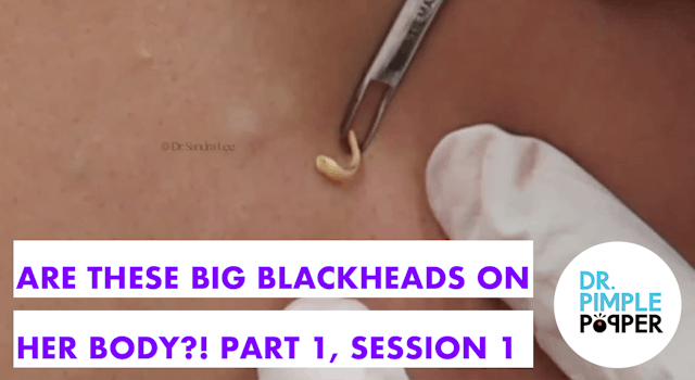 Are These Big BLACKHEADS on her Body? Part 1, Session 1