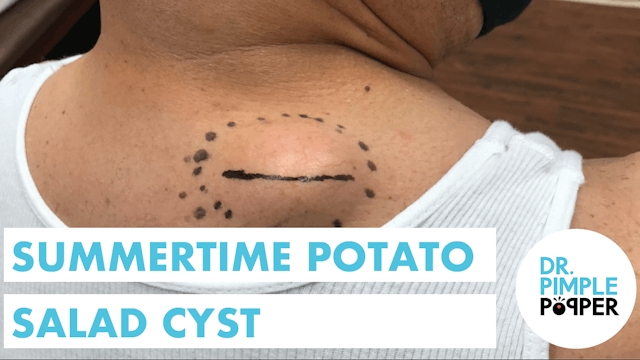 A Summertime Potato Salad Cyst in the...