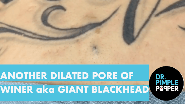 Another Dilated Pore of Winer, aka gi...