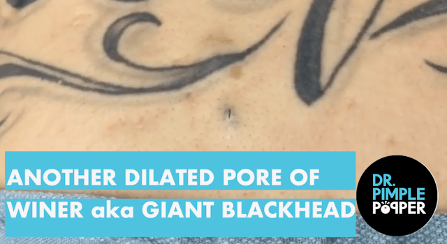 Another Dilated Pore of Winer, aka giant blackhead