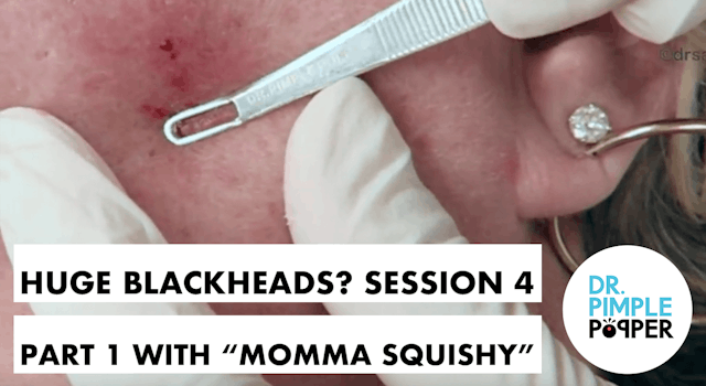 WEB EXCLUSIVE SNEAK PEEK: Huge Blackheads?! Session 4 Part One with "Momma Squishy"
