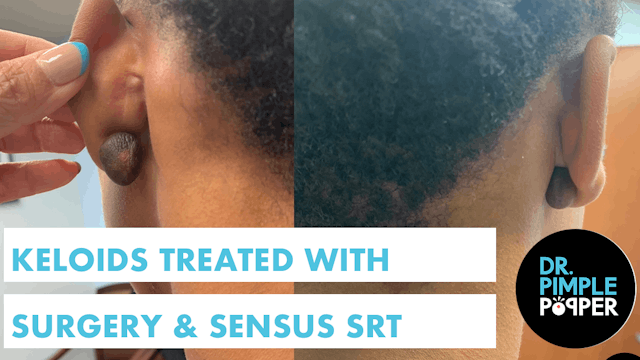 Keloids Treated with Surgery & Sensus...