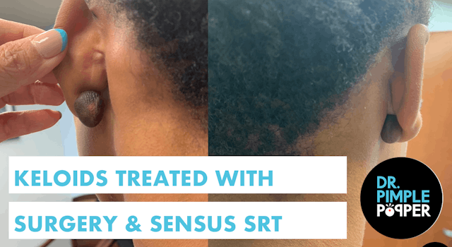 Keloids Treated with Surgery & Sensus...