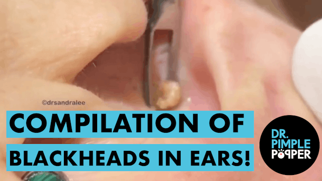 A Compilation of Blackheads in The EARS