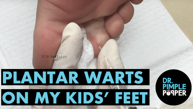 Plantar Warts on My Kid's Feet