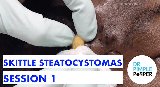 Forehead & More, Steatocystomas Session 1 (skittle)