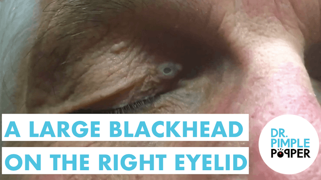 A Large Blackhead on the Right Eyelid.. Maybe even a Dilated Pore of Winer?