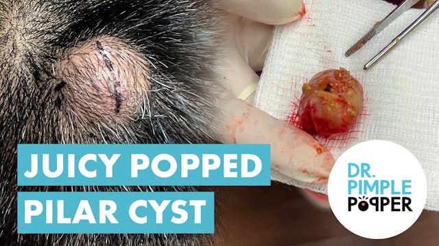A Popped Pilat Cyst! Dr Pimple Popper vs Juicy Popped Pilar Cyst