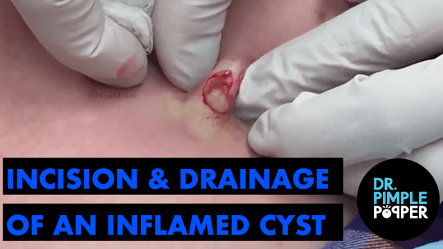 I & D (Incision & Drainage) of an Inf...