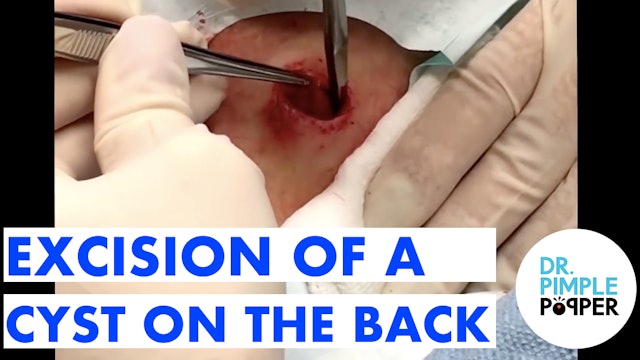 Excision of a Cyst on the Back Part 1 of 2