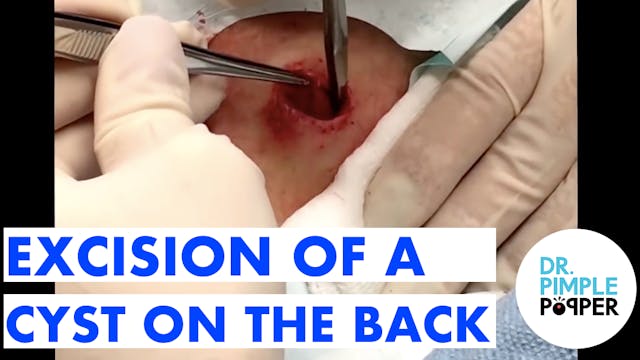 Excision of a Cyst on the Back Part 1...